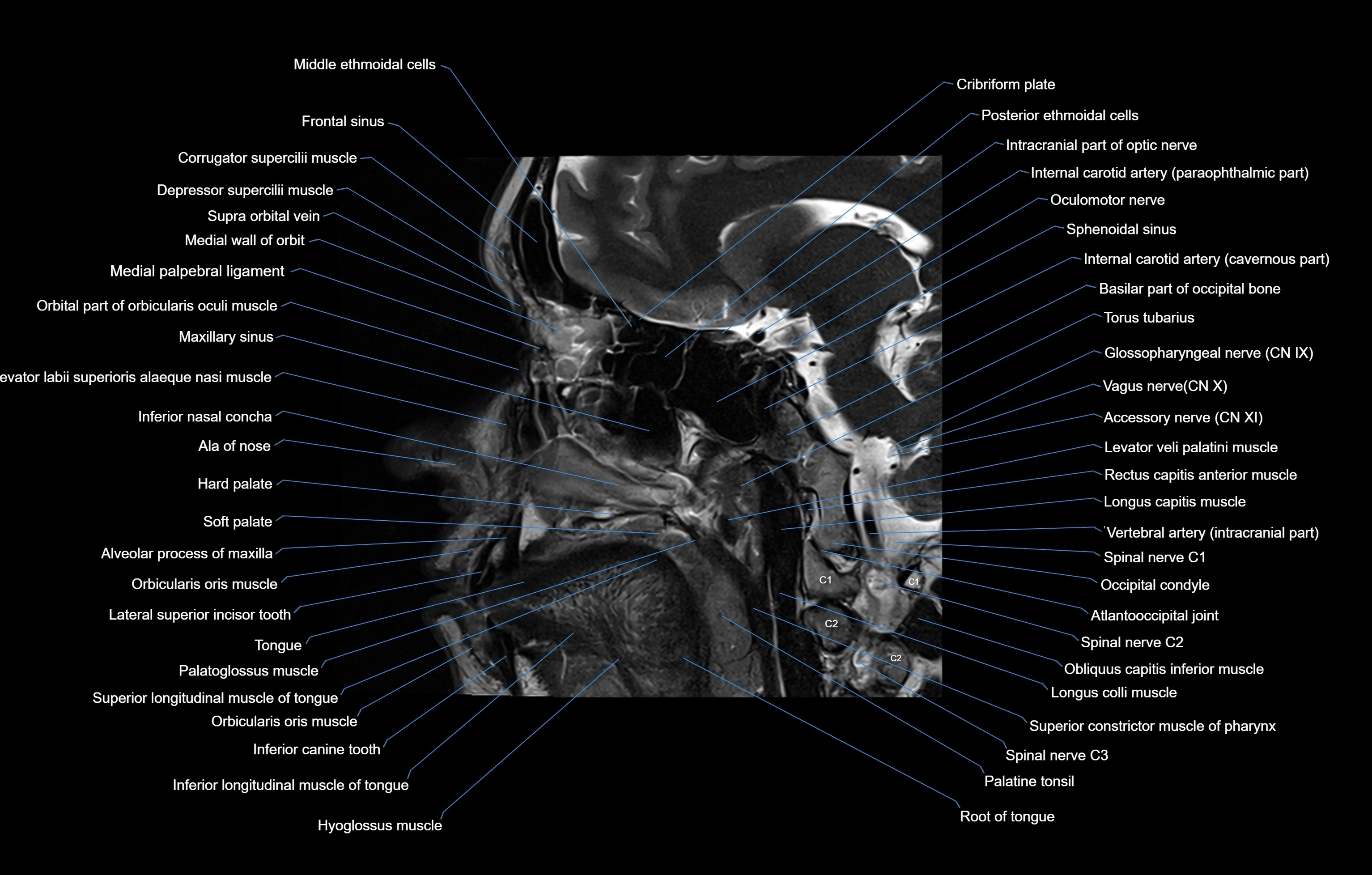 paranasal sinuses(PNS) MRI coronal  cross sectional anatomy 3T radiology  image-img-00001-00007.webp